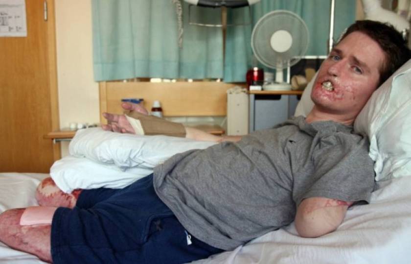 Βρετανία: Έχασε τα άκρα του από λοίμωξη που «τρώει» τη σάρκα (pics)