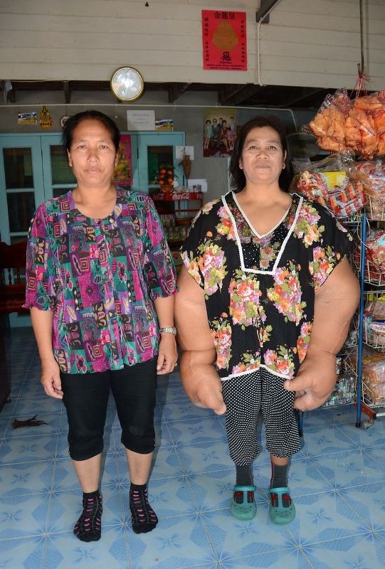  Ταϋλάνδη: Η γυναίκα με τα μεγαλύτερα χέρια στον κόσμο (photos)