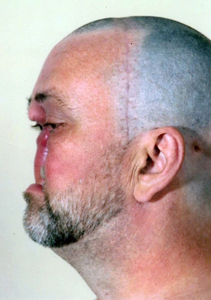Ο καρκίνος του άφησε μία τεράστια τρύπα στο πρόσωπο (pics)