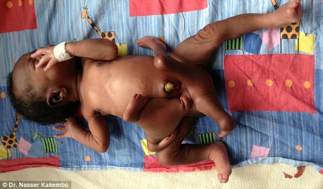 Επέμβαση σε βρέφος που γεννήθηκε με 4 χέρια και 4 πόδια (pics)