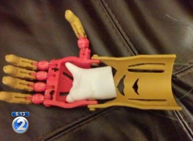 Αγόρι που γεννήθηκε χωρίς δάχτυλα, αποκτά το χέρι του Iron man (pics+video)