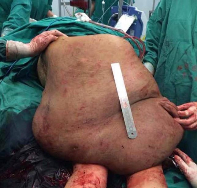 Αφαίρεσαν όγκο βάρους 25 κιλών από την πλάτη γυναίκας! (σκληρές εικόνες)
