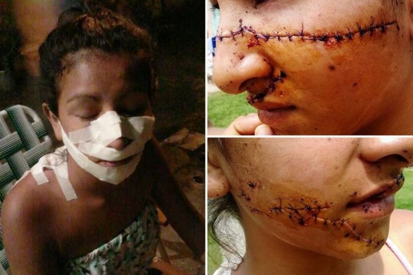 Αργεντινή: Πρωτοφανής επίθεση σε 15χρονη επειδή ήταν πολύ όμορφη (pics)