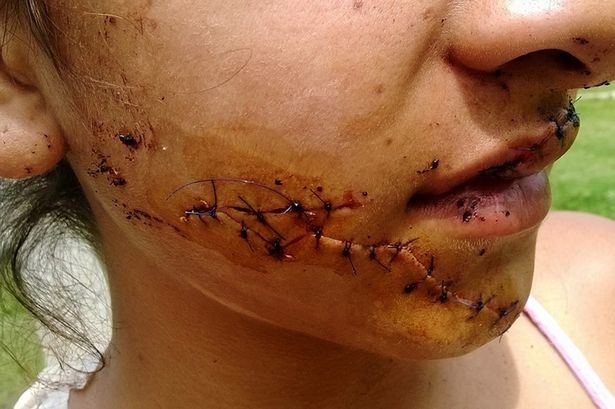 Αργεντινή: Πρωτοφανής επίθεση σε 15χρονη επειδή ήταν πολύ όμορφη (pics)