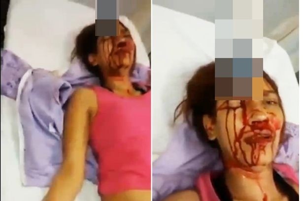Τη μαχαίρωσαν στο μέτωπο με κουζινομάχαιρο και επιβίωσε! (βίντεο-σκληρές εικόνες)