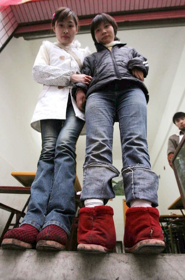 Κίνα: Η γυναίκα που γεννήθηκε με τα πόδια ανάποδα! (pics)