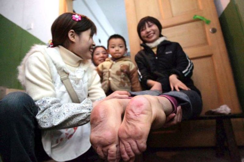 Κίνα: Η γυναίκα που γεννήθηκε με τα πόδια ανάποδα! (pics)