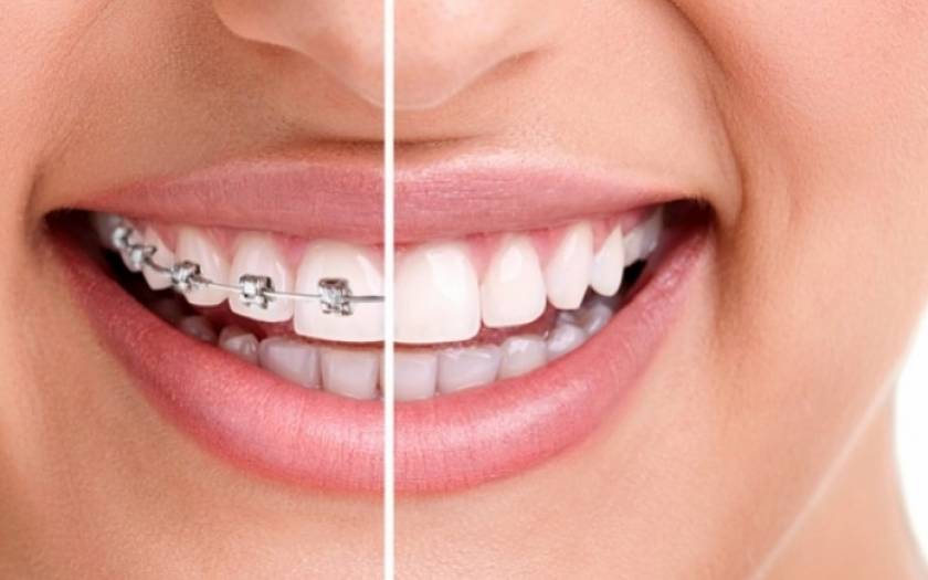 Δείτε σε 30 δευτερόλεπτα πώς τα σιδεράκια διορθώνουν τα δόντια