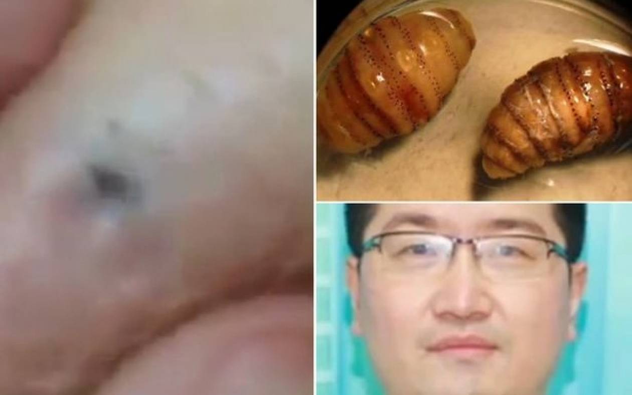Κίνα: Είχε μέσα στο δέρμα του 20 ζωντανά σκουλήκια (video)