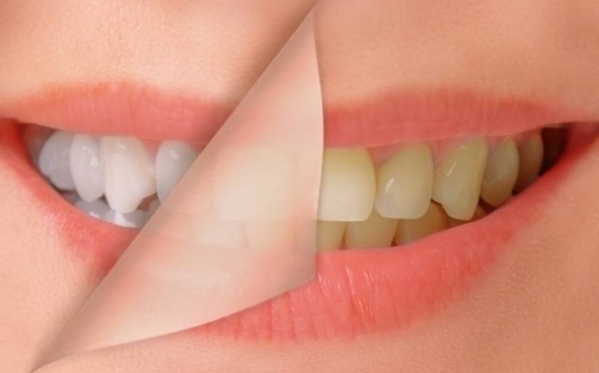 Δείτε για ποιους λόγους κιτρινίζουν τα δόντια σας