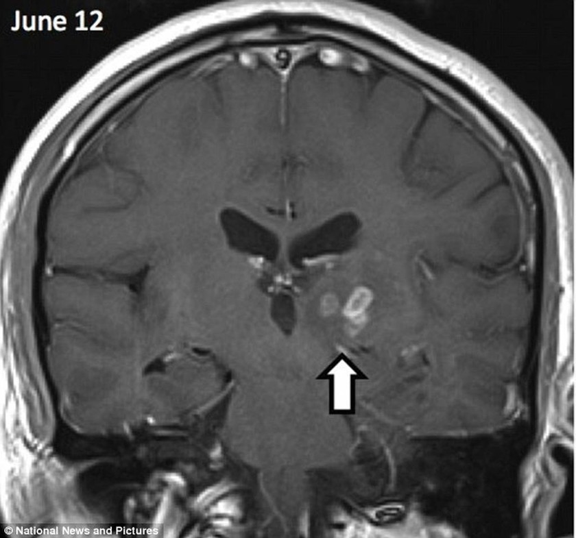 Παράσιτο ζούσε στον εγκέφαλο ανθρώπου τέσσερα χρόνια (pics)