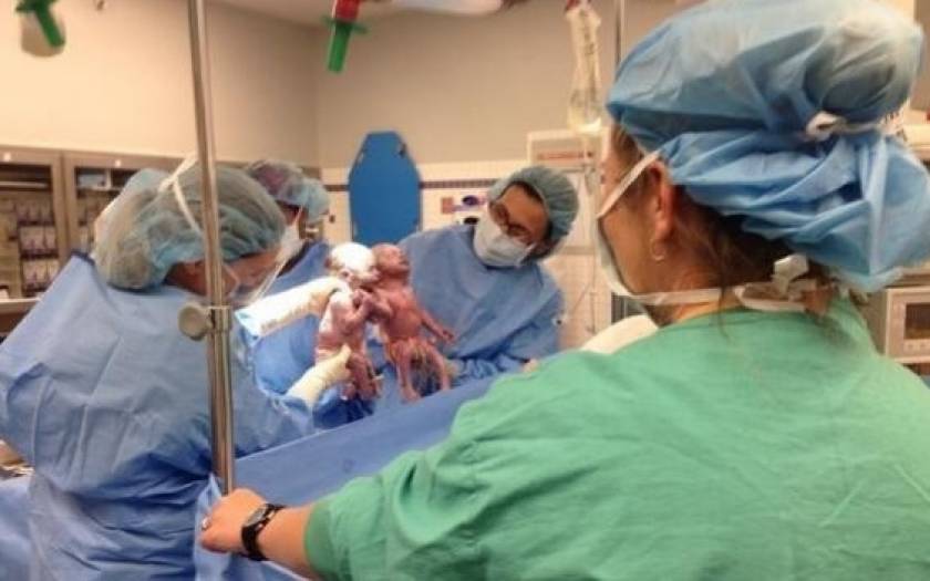 Αχώριστα τα μωρά που γεννήθηκαν χέρι-χέρι (Βίντεο)
