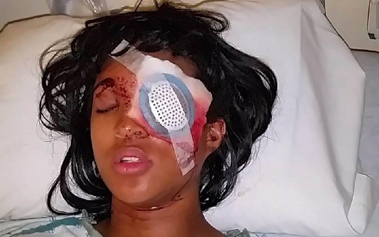Φέργκιουσον: Έγκυος έχασε το μάτι της από πυρά αστυνομικού