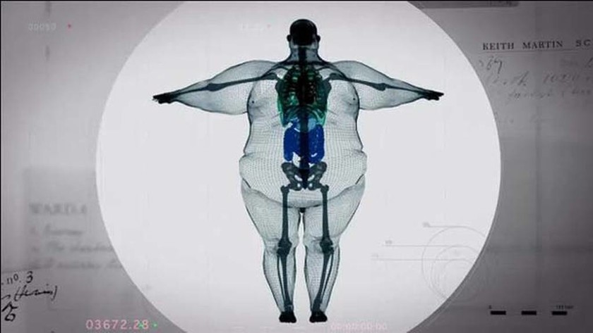 ΣΥΓΚΛΟΝΙΣΤΙΚΟ: Δείτε τις ακτινογραφίες ενός ανθρώπου 445 κιλών (pics)