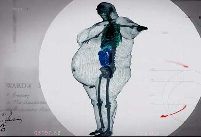 ΣΥΓΚΛΟΝΙΣΤΙΚΟ: Δείτε τις ακτινογραφίες ενός ανθρώπου 445 κιλών (pics)