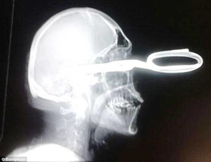 Βραζιλία: Πήγε στα επείγοντα με καρφωμένο ένα ψαλίδι στο κεφάλι του (pics)