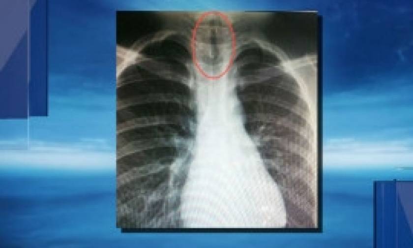 Απίστευτο: Δείτε τι βρήκαν οι γιατροί στον πνεύμονα 11χρονου αγοριού (Photos)