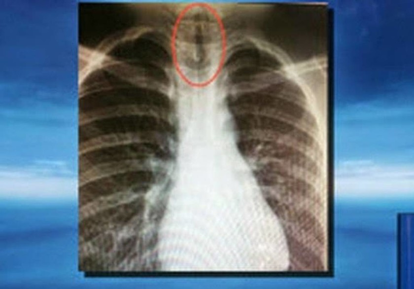 Απίστευτο: Δείτε τι βρήκαν οι γιατροί στο πνεύμονα 11χρονου αγοριού (Photos)