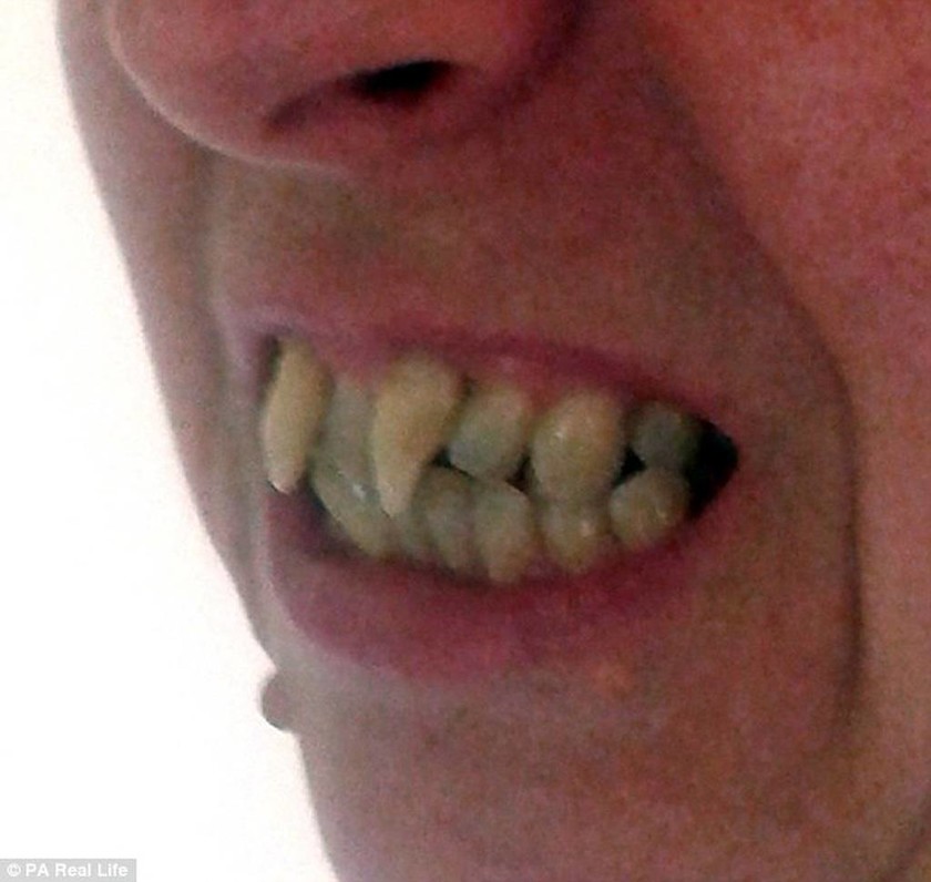 H γυναίκα που έβγαλε δόντια βαμπίρ (photos)