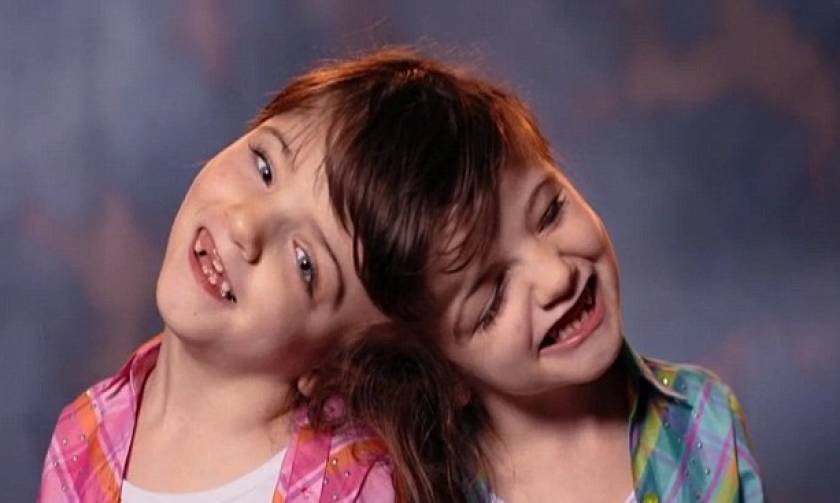 Τα σιαμαία κοριτσάκια που είναι αναγκασμένα να ζουν για πάντα μαζί αφού έχουν έναν εγκέφαλο