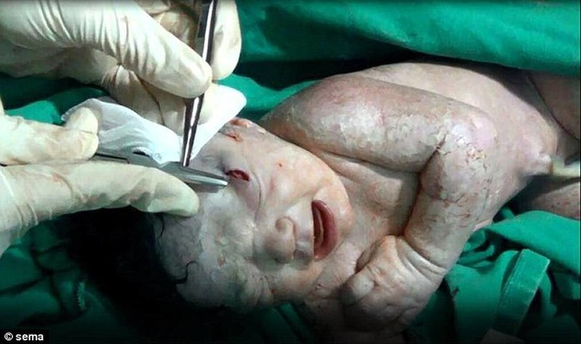 Συγκλονιστικό: Μωρό γεννήθηκε με θραύσματα στο κεφάλι μετά από έκρηξη βόμβας (video)