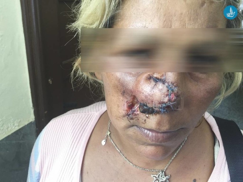 Ρόδος: Απίστευτο περιστατικό βίας - Της δάγκωσαν και της έκοψαν τη μύτη!! (pic)