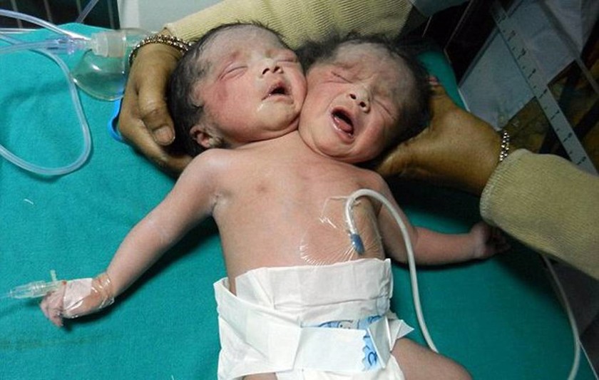 Ιατρικό θαύμα: Μωρό με δύο κεφάλια γεννήθηκε στο Μπανγκλαντές (photos)