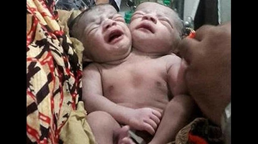 Ιατρικό θαύμα: Μωρό με δύο κεφάλια γεννήθηκε στο Μπανγκλαντές (photo)