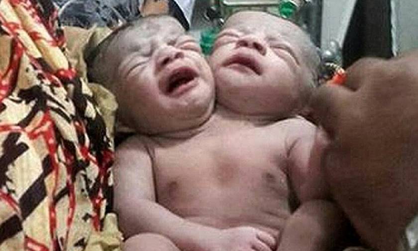 Γεννήθηκε μωρό με δύο κεφάλια - Μόλις 50% οι πιθανότητες να επιζήσει