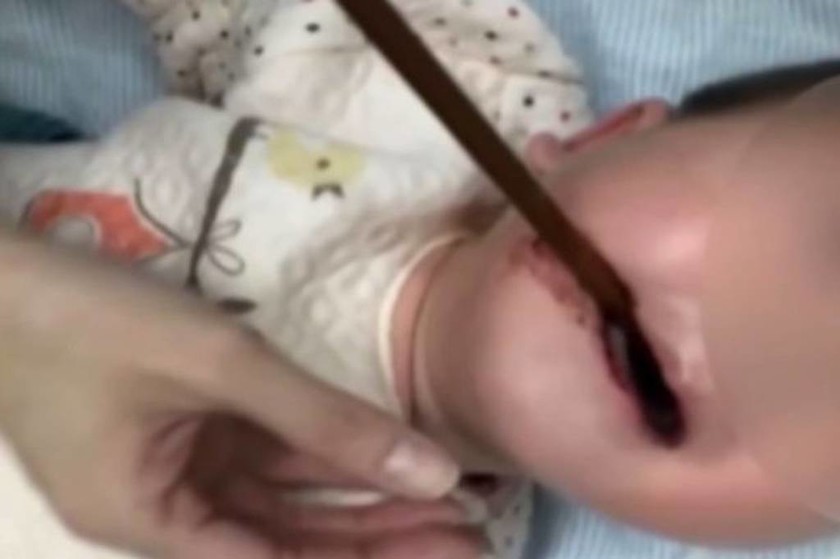Φρικιαστικό ατύχημα: Chopstick καρφώθηκε στον ουρανίσκο μωρού (σκληρές εικόνες)