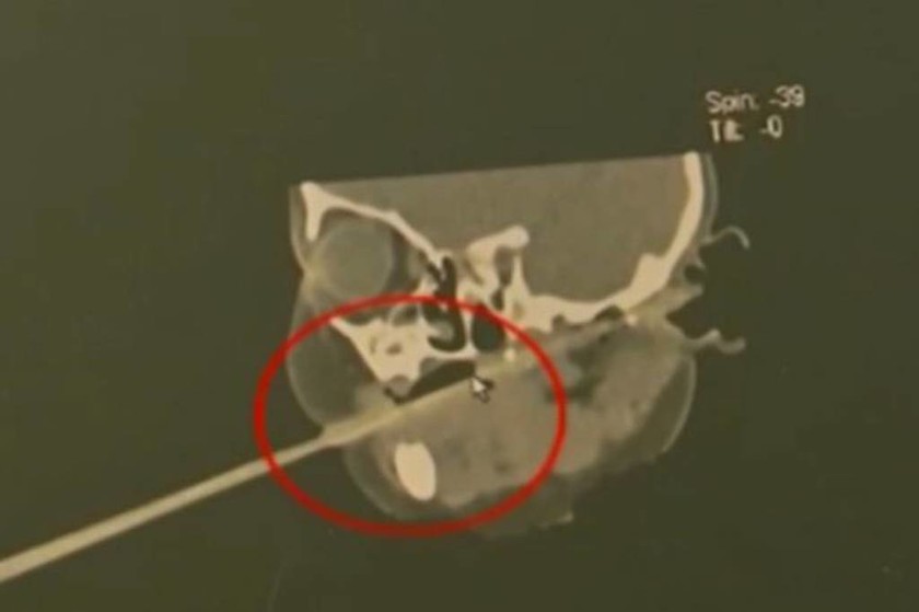 Φρικιαστικό ατύχημα: Chopstick καρφώθηκε στον ουρανίσκο μωρού (σκληρές εικόνες)