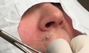 Δείτε τι αφαίρεσε χειρουργός πάνω από το χείλος της και φρίκαρε!  (video)