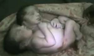 Μωρό θαύμα με δύο κεφάλια αψηφά την ιατρική και παραμένει ζωντανό μετά τη γέννησή του! (video)