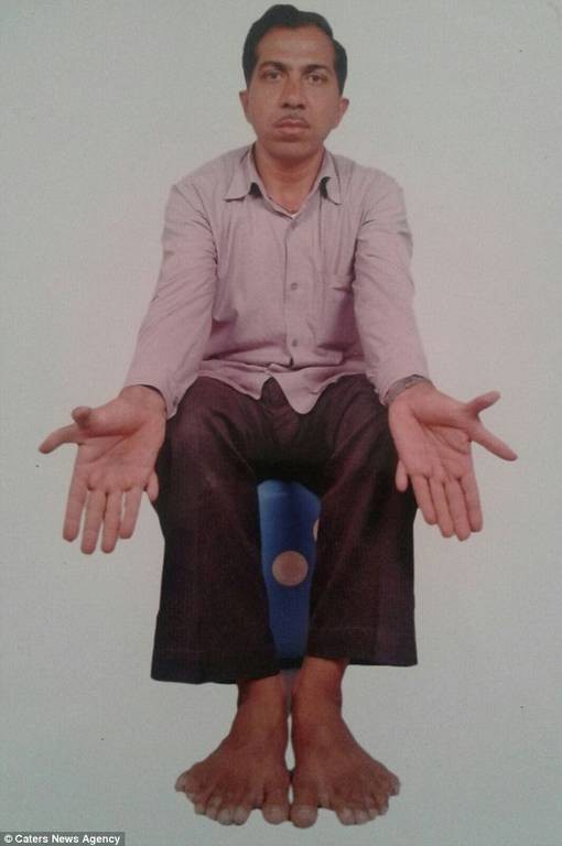 Ινδία: Ο άνθρωπος με τα περισσότερα δάχτυλα στον κόσμο! (pics)