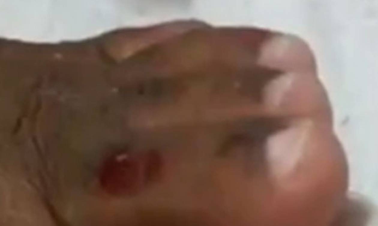 Τρομακτικό βίντεο: Μαζί με το νύχι του βγήκε και κάτι… ζωντανό! (σκληρές εικόνες)