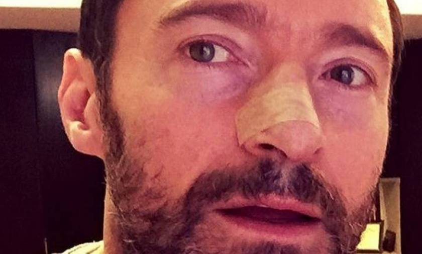 Χιου Τζάκμαν: Mε selfie στο Instagram, ο Wolverine πολεμάει τον καρκίνο