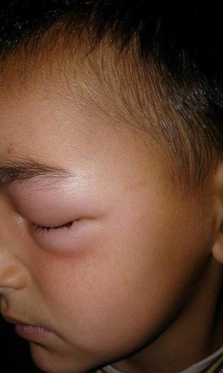 ΣΟΚ στη Θεσσαλονίκη: Δείτε πώς έγινε το μάτι παιδιού από τσίμπημα κουνουπιού! (pics)