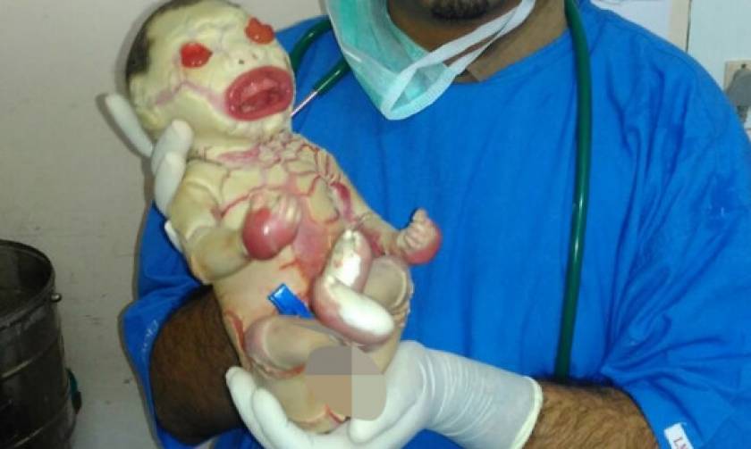 ΠΡΟΣΟΧΗ ΣΚΛΗΡΕΣ ΕΙΚΟΝΕΣ: Βρέφος γεννήθηκε χωρίς δέρμα (video)