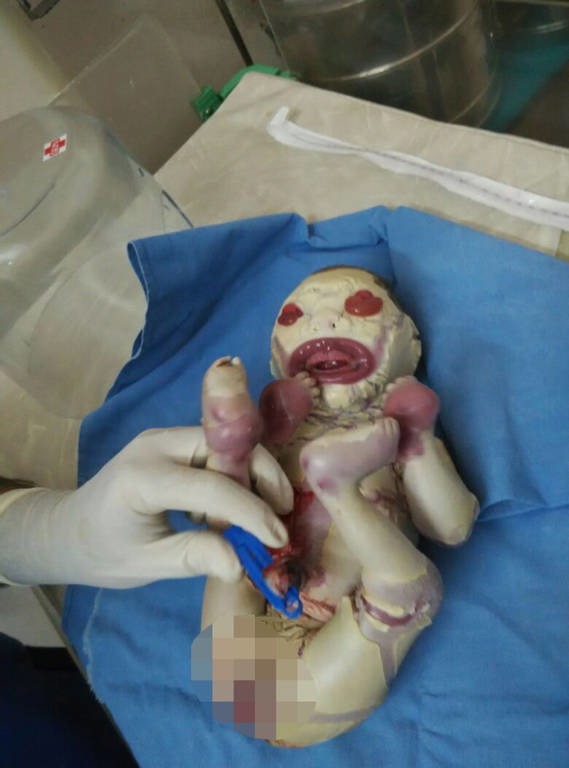 ΠΡΟΣΟΧΗ ΣΚΛΗΡΕΣ ΕΙΚΟΝΕΣ: Βρέφος γεννήθηκε χωρίς δέρμα (video)