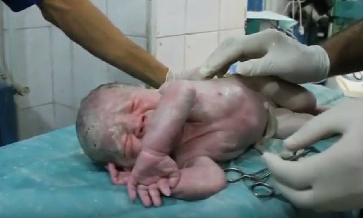 Συγκλονιστικό βίντεο: Γιατροί στη Συρία επανέφεραν στη ζωή νεογέννητο αγοράκι