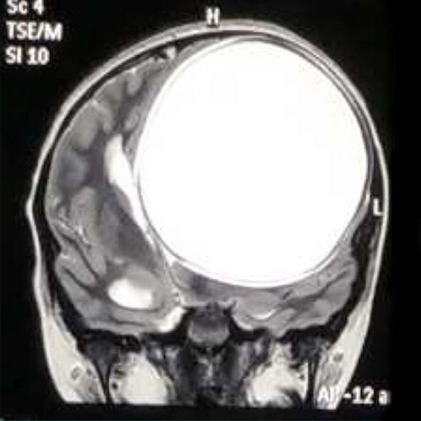 Υπέφερε από δυνατούς πονοκεφάλους και οι γιατροί ανακάλυψαν κάτι φρικιαστικό! (video+photos)  