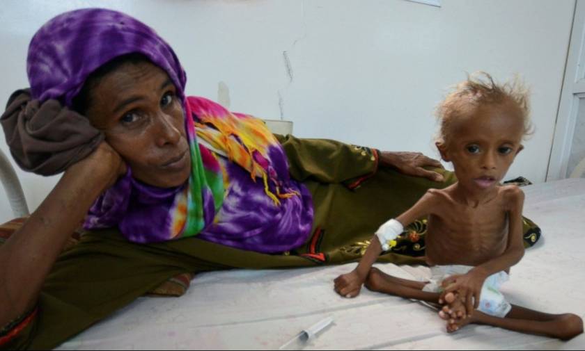 Υεμένη: Σοκάρει η εικόνα του υποσιτισμένου παιδιού που αποτυπώνει τη φρίκη του εμφυλίου