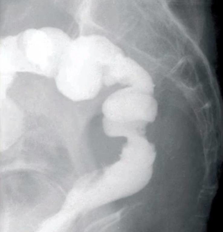 Αηδιαστική φρίκη: Χειρουργοί ένωσαν το παχύ έντερο γυναίκας με τον κόλπο της! (photos)