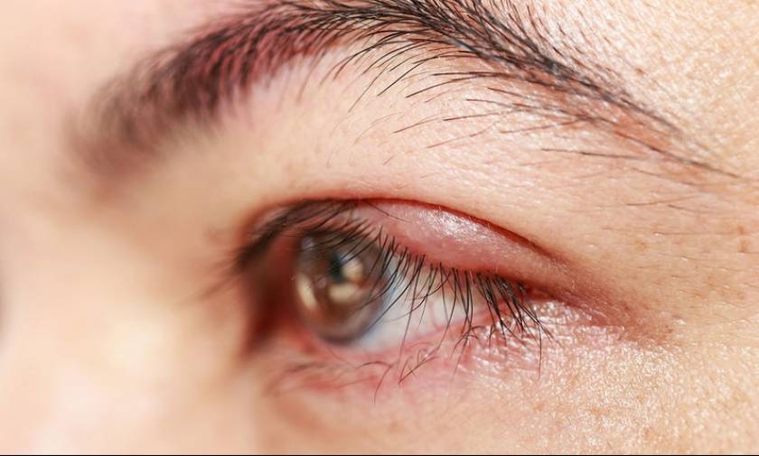 Κριθαράκι στο μάτι: Πότε πρέπει να επισκεφτείτε γιατρό