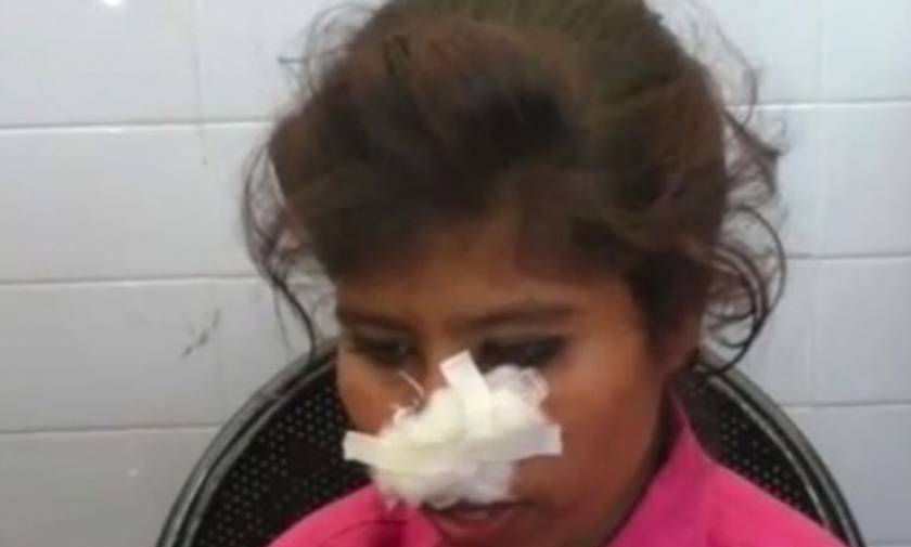 ΣΚΛΗΡΕΣ ΕΙΚΟΝΕΣ: Οι γονείς της δεν του πήραν μοτοσικλέτα και αυτός της έκοψε τη μύτη με τα δόντια