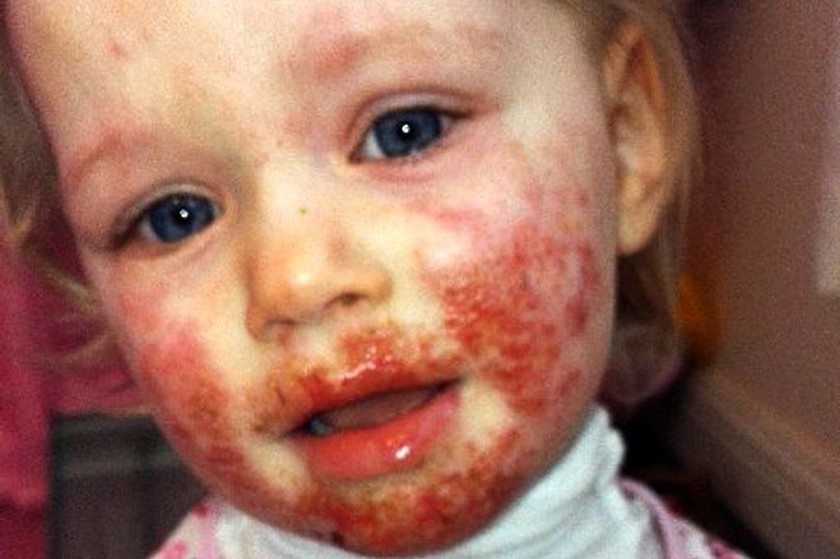 «Σαρκοφάγος» ιός τρώει το πρόσωπο αυτού του κοριτσιού. Πώς κόλλησε θα σας σοκάρει ακόμα περισσότερο!