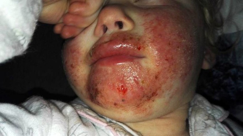 «Σαρκοφάγος» ιός τρώει το πρόσωπο αυτού του κοριτσιού. Πώς κόλλησε θα σας σοκάρει ακόμα περισσότερο!