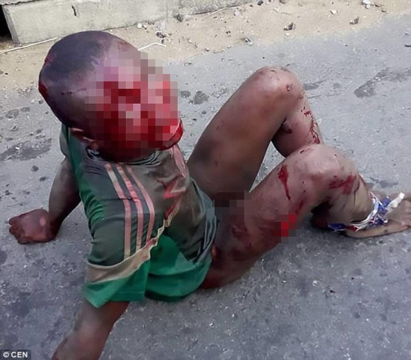 Σκληρές εικόνες - Η απόλυτη φρίκη: Έβαλαν φωτιά σε 7χρονο που έκλεψε για να φάει