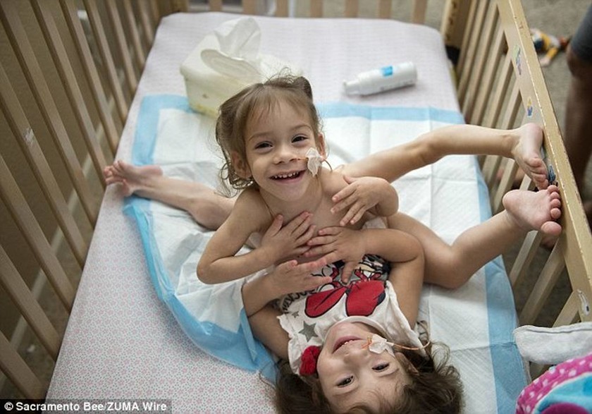 ΗΠΑ: Σιαμαία κοριτσάκια διαχωρίστηκαν επιτυχώς έπειτα από επέμβαση 17 ωρών! (pics)