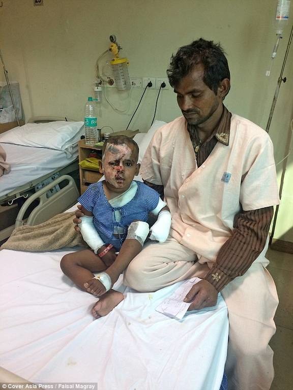 Σοκαριστικό: Επιτέθηκαν με οξύ σε 2χρονο αγόρι στην Ινδία (pics)